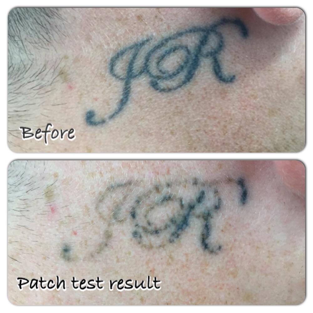 Perfluorodecalininfused patch in picosecond and Qswitched laserassisted tattoo  removal Safety in Fitzpatrick IVVI skin types  Vangipuram  2019   Lasers in Surgery and Medicine  Wiley Online Library