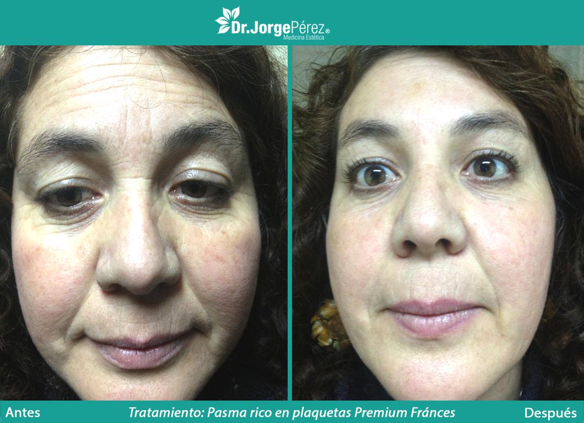 drjorge_perez's tweet photo. Foto con 30 días de diferencia, la duración es para toda la vida. #estetica #viñadelmar #plasmaricoenplaquetas http://t.co/qBinD9eKi5