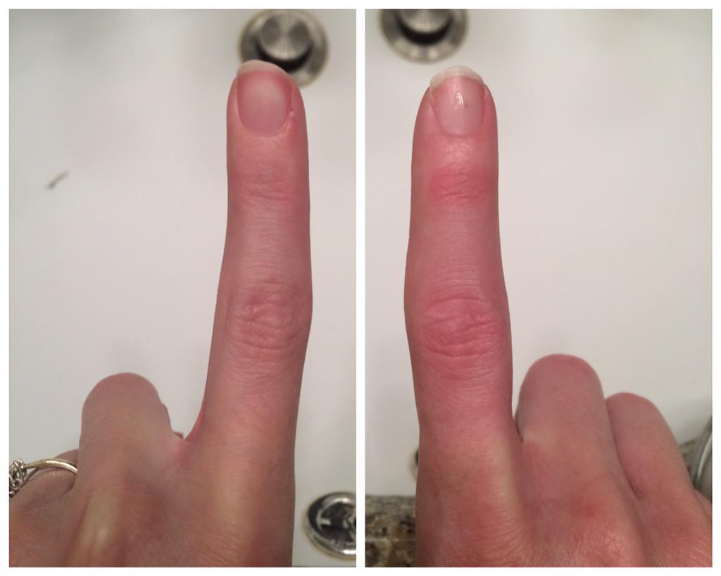 Bro__okLem's tweet image. My right finger is significantly larger than the left rn. #swelling #help #RIPbrook