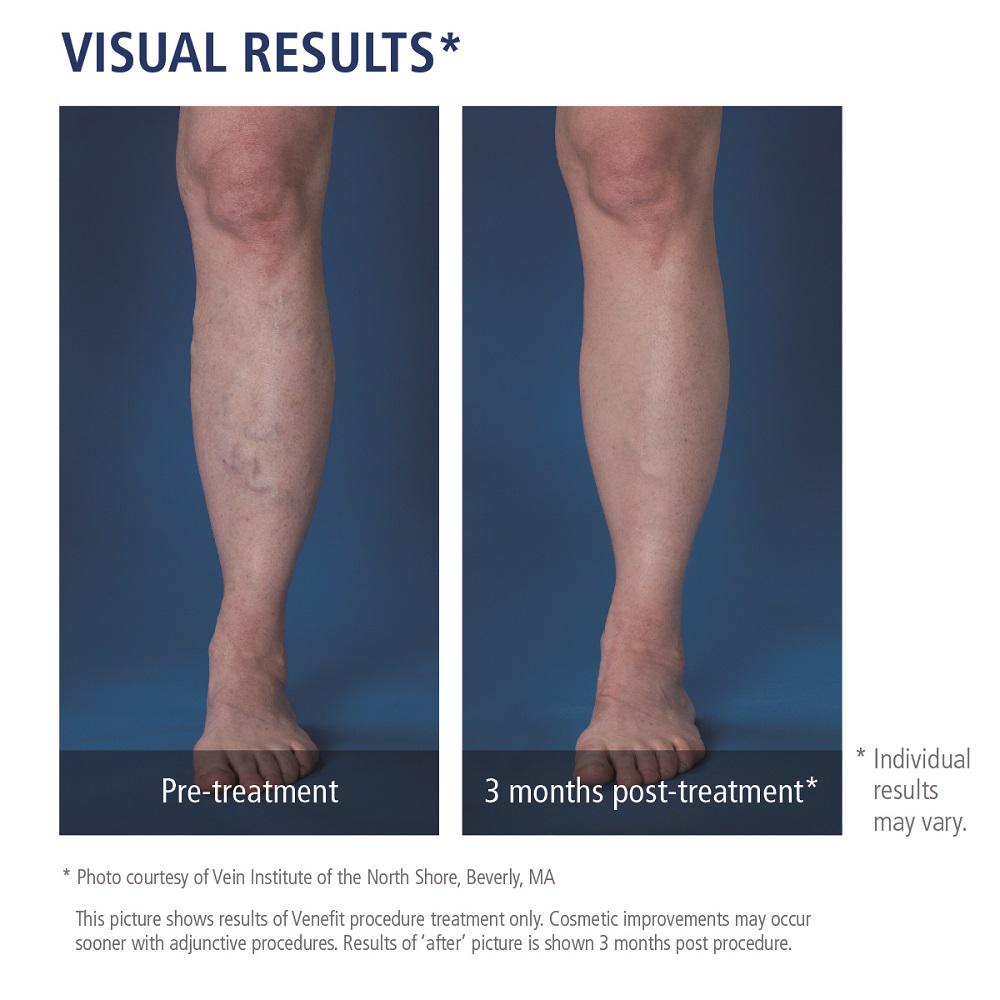 Did you know women are more likely to develop #varicoseveins? ow.ly/QtsdU