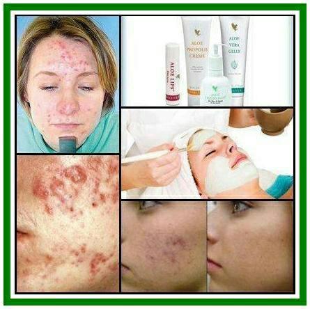 lee316's tweet photo. Propolis Creme, Aloe Vera Gelly, Aloe Lips and Aloe Liquid Soap for Acne :) http://t.co/O6NO9dWaFz