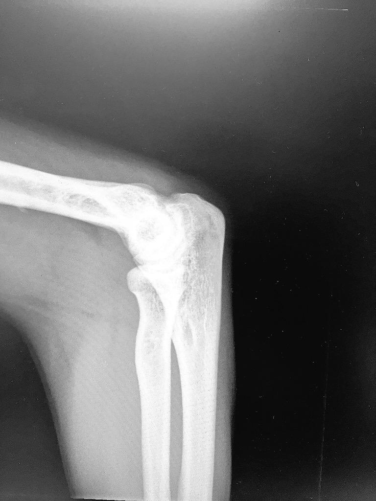PoolOfficial's tweet photo. Jup, so this is my elbow.
Looks healthy to me. #dannyatthedoctor #poolofficial http://t.co/RXAkXR3HgU