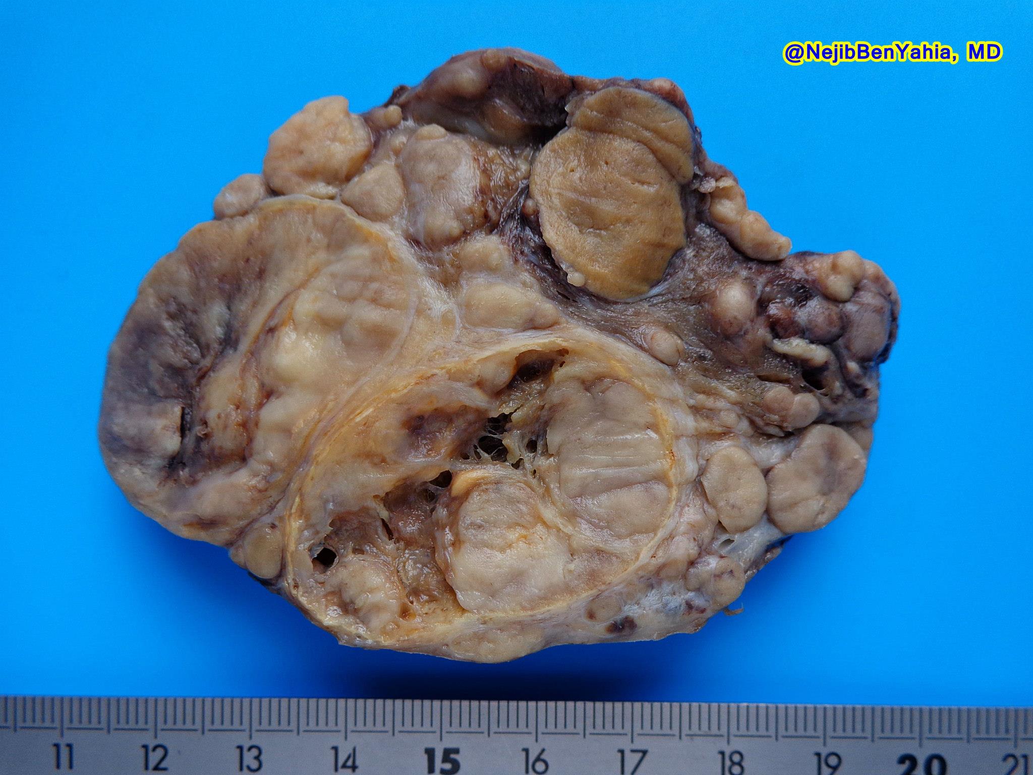 papillary thyroid carcinoma gross
