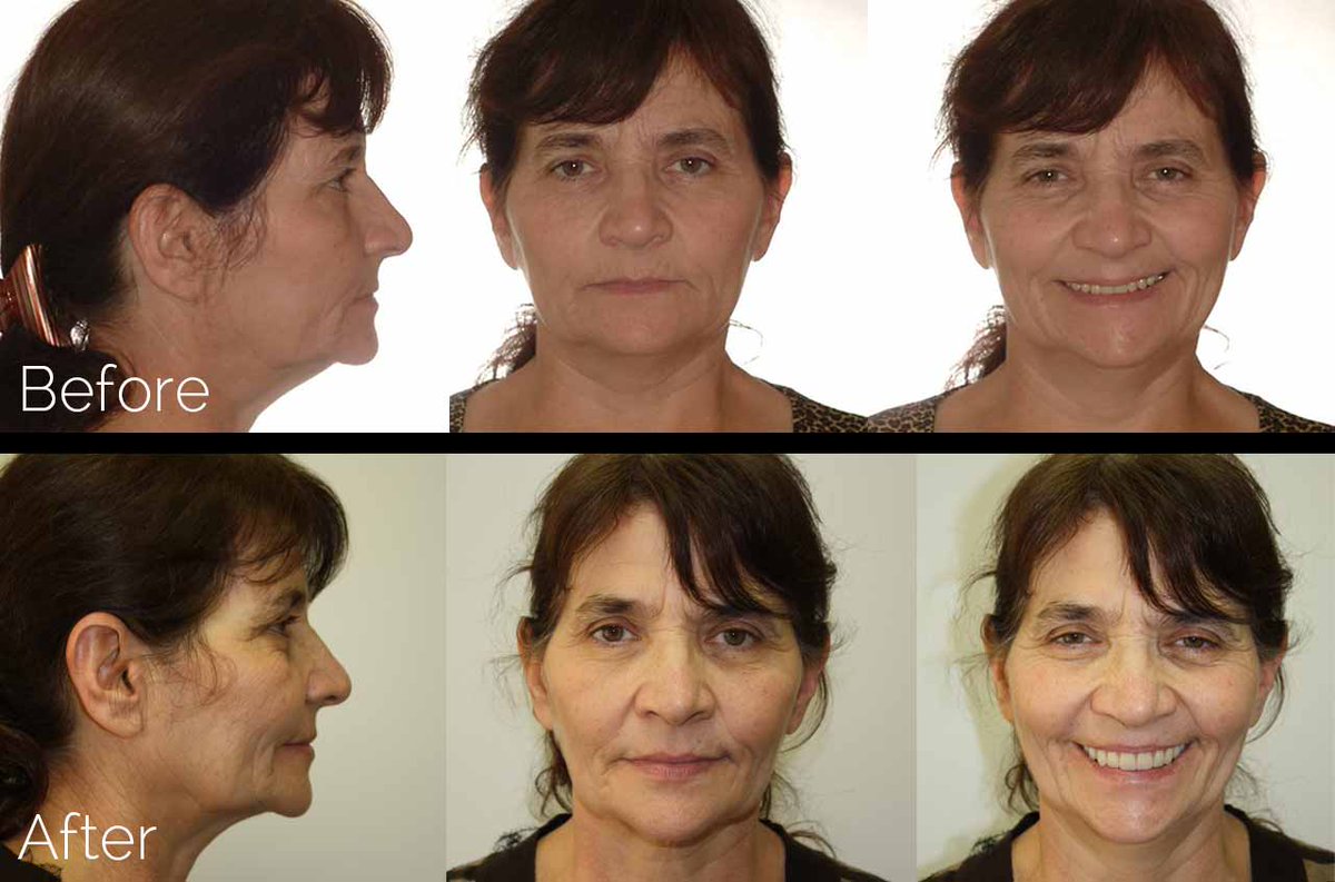 All-on-4 Teeth-in-a-Day™ #DentalImplants <a href="/aaoms/">AAOMS - Oral and Maxillofacial Surgeons</a> <a href="/Smile4Health/">Hertha Latimer</a> Extractions with Alveoloplasty and Immediate #Implants