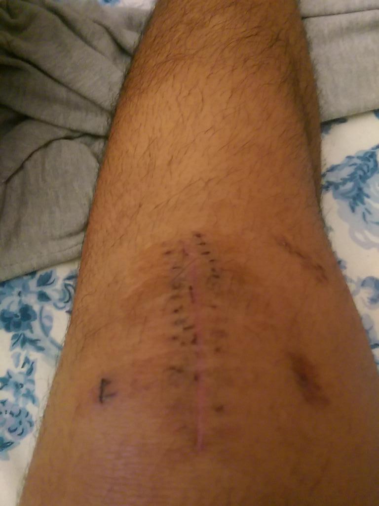 america934457's tweet photo. 4 weeks down and doing some improvement #aclproblem #meniscusproblem http://t.co/vQ2civpbeX