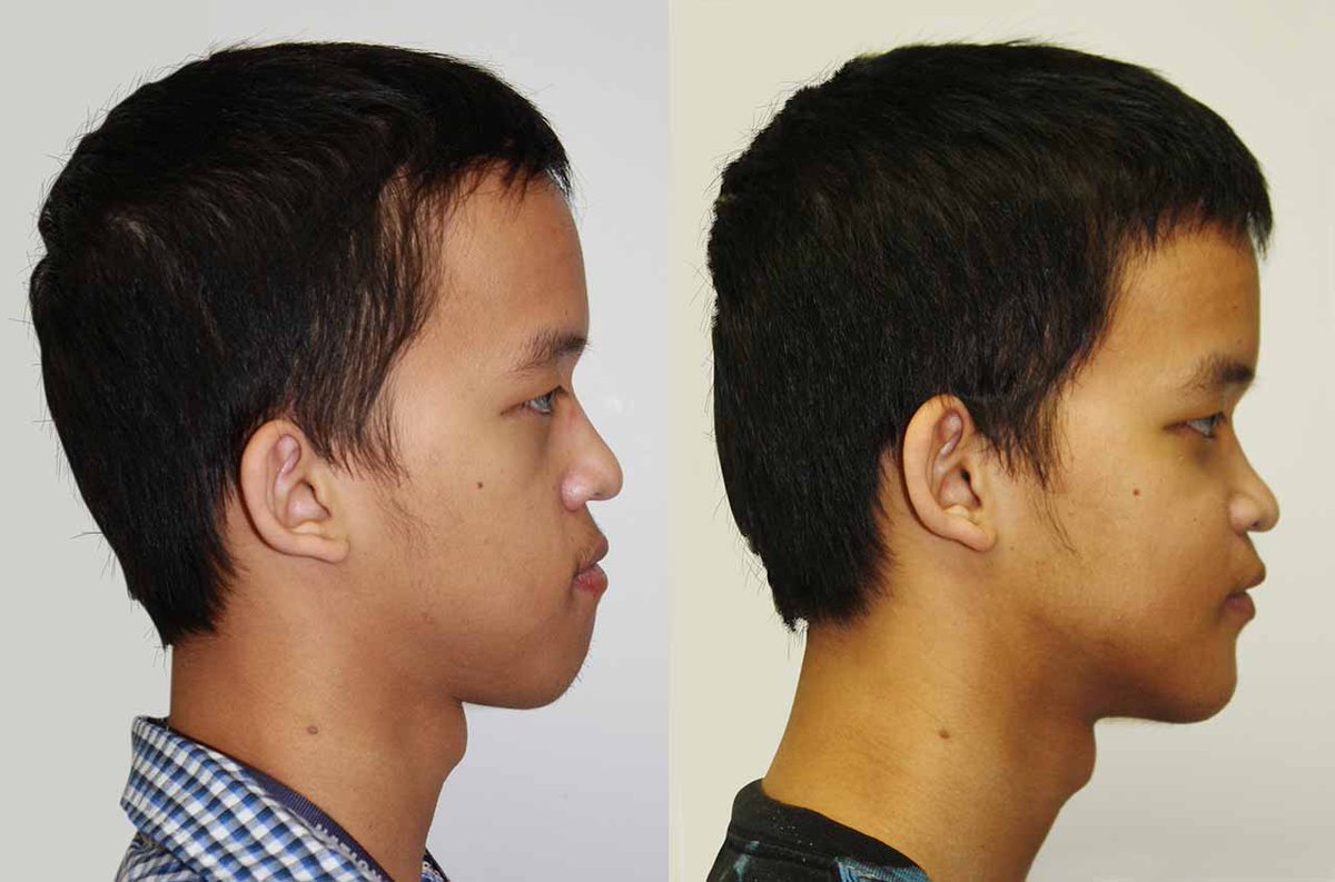 Facial Asymmetry Correction, Corrective #JawSurgery bit.ly/1K4tDUH #oralsurgery #orthognathicsurgery