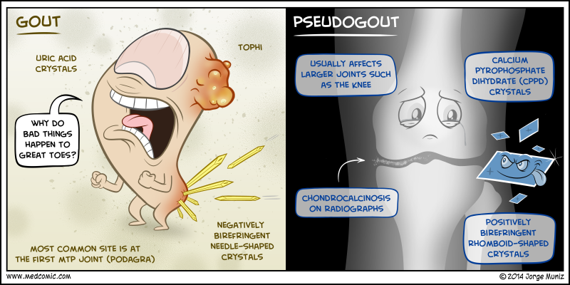 gout vs pseudogout crystals