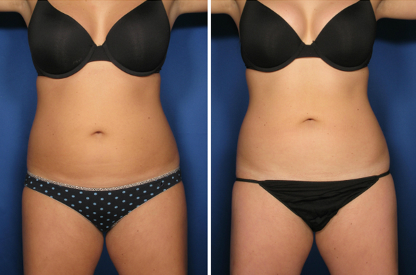 HeliosMedSpa's tweet photo. #coolsclupting works! It really is the procedure that does what diet and exercise can't. Call us for a free consult. http://t.co/PTt1yIEk4V