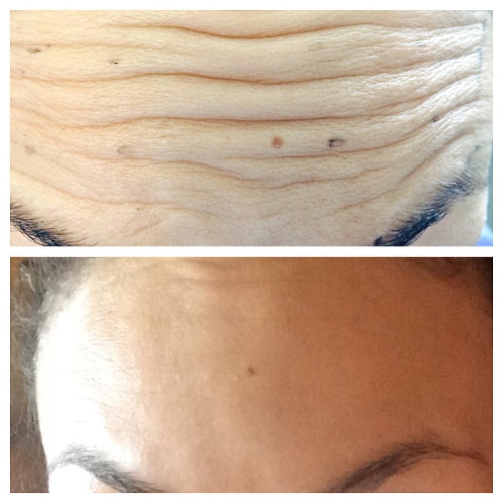 Now see them ... Now you don't #botox Another happy client 😊