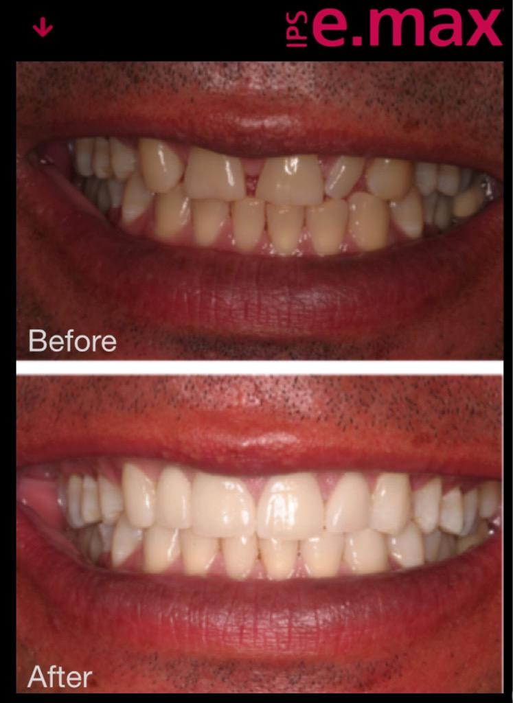 soubt's tweet photo. Smile to the max 6, source smile to the max app. #emax, #allceramic, #ipsemax http://t.co/woh4Yetn7C
