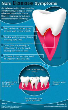 SynergyDDS's tweet photo. Gum Disease Symptoms http://t.co/SPkzVD537h