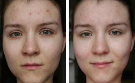 opatra advanced skincare dermisonic device