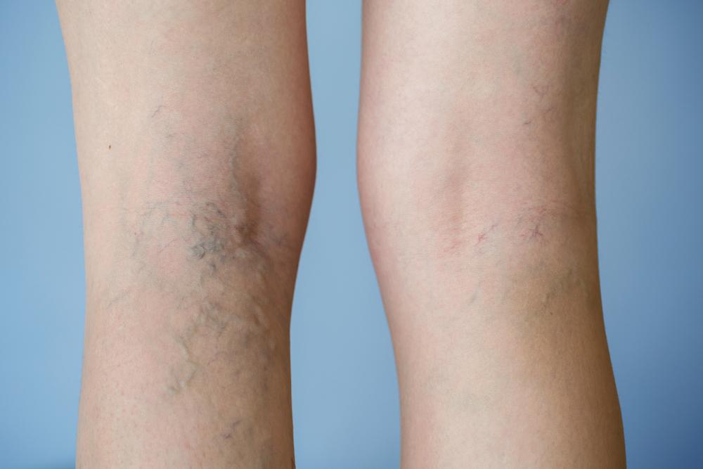 Vein problems? We can help. Call for a consultation: (305) 822-0068.