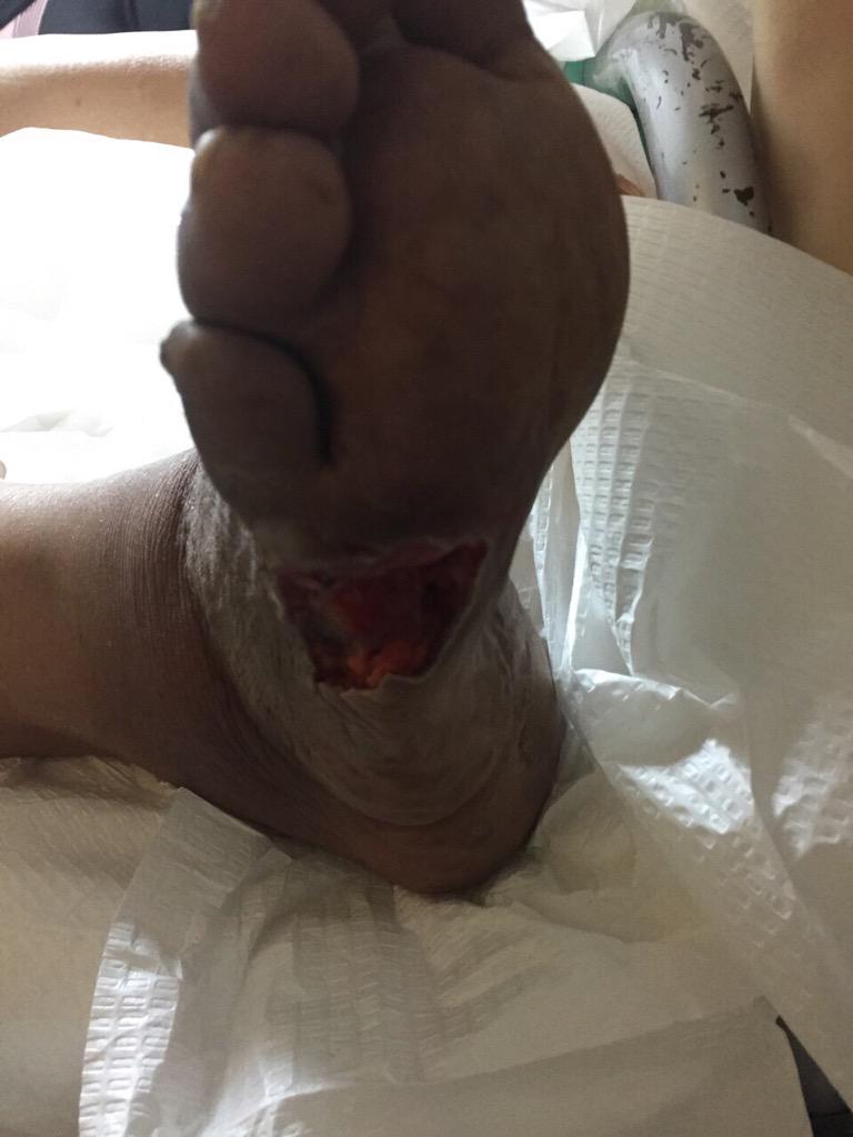 byaarg's tweet photo. حصل معه مضاعفات خطيره بسبب هذا الخطأ ولا نزال نعاني من مماطلة مستسفى الفروانيه ومحاولة تدارك خطأ زميلهم@HBuyabes http://t.co/5TOwzA3evP