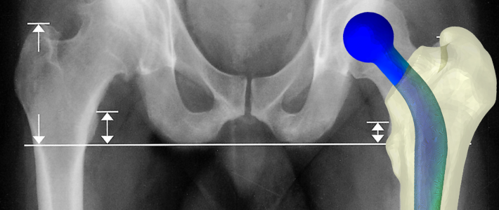 OptimalDevice's tweet photo. Overview of the process of converting femur scan to #FEA model with #Simulia #Abaqus #3DS #Simpleware #biomechanical http://t.co/CxX5nz5wAn