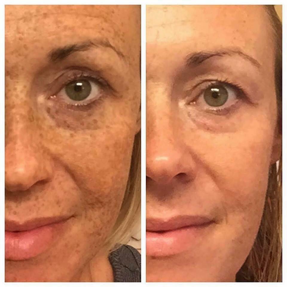 d_murphy6's tweet photo. Too much sun this summer?  Message me and we will REVERSE that damage and get you back into healthy skin again! http://t.co/x4SCMOd0F8