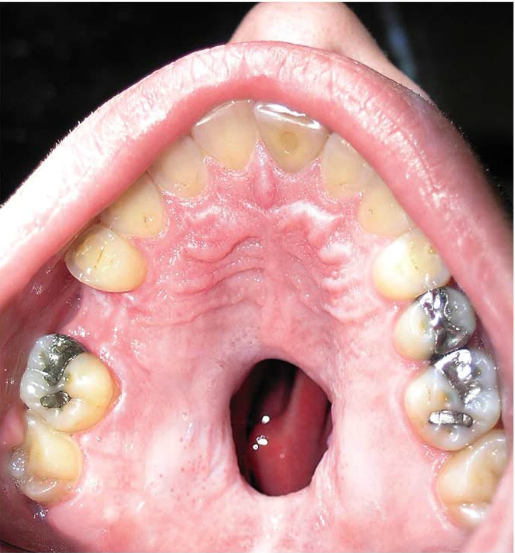 TheNewImpostor's tweet photo. Vasoconstriction from cocaine use can produce a hole in the palate of users' mouths http://t.co/IIsTgsYtg1 http://t.co/Xz9ra1JsO4