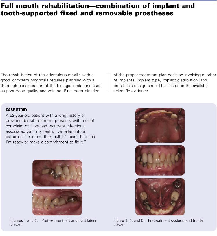 aboutDent's tweet photo. #Case24:Full mouth rehabilitation combination of implant and tooth-supported fixed and removable prosthese
#Aboutdent http://t.co/Mn6eO7eLYn