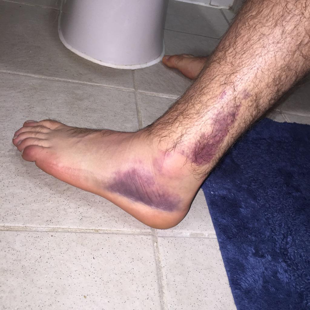 CoreyLA14's tweet image. Well X-rays came back this morning and it's Fractured!! 😐 how exciting #NotMyWeek #FracturedAnkle #MilitaryUSAF
