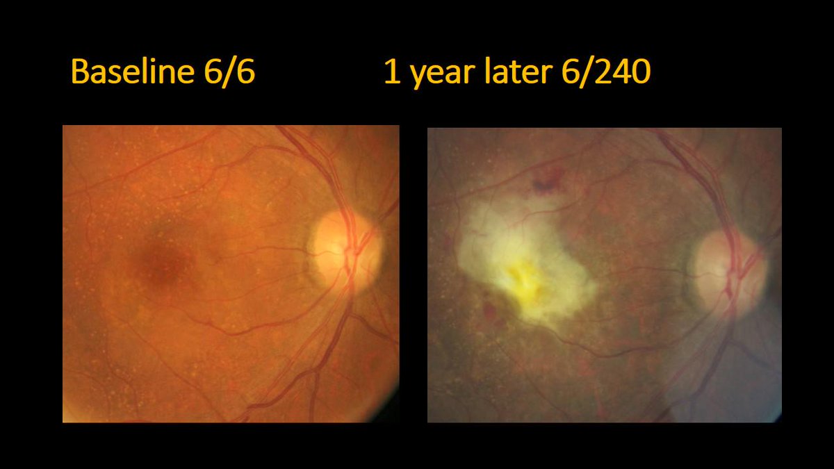 eye_kelly's tweet image. Delayed diagnosis of wet-AMD or in access to anti-VEGF #eyeinjection leads to vision loss. #ClinNeg claim may follow