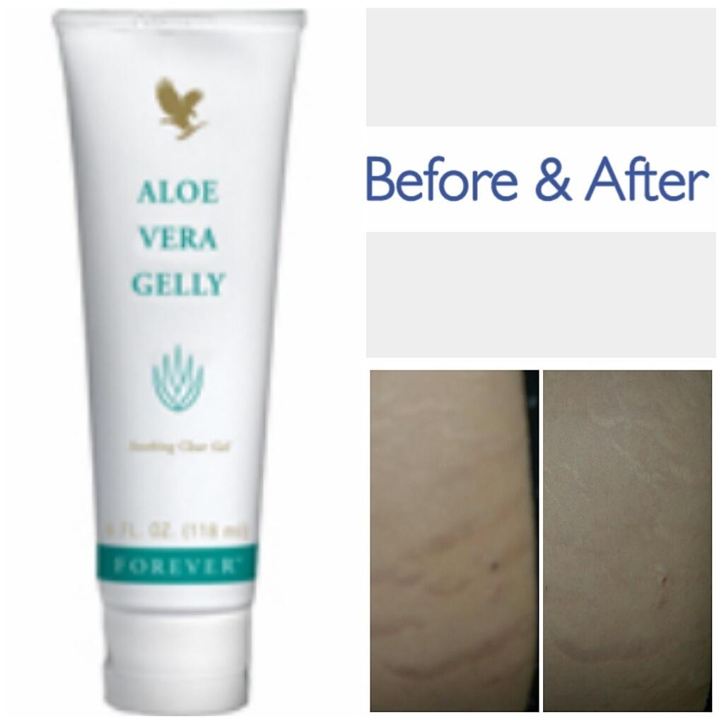 forever living products for stretch marks