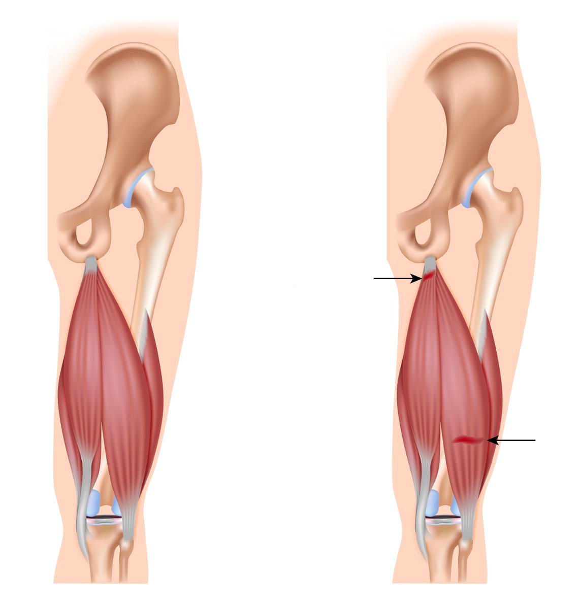 TheAMSSM's tweet photo. #ICYMI: Don't let #hamstringstrains keep you sidelined. Learn more at http://t.co/Sltmbzq2RM  #sportsmedtoday http://t.co/sLjGtqZR7D