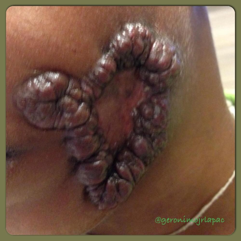 GeronimoJrLapac's tweet image. Kaposiform hemangioendothelioma.