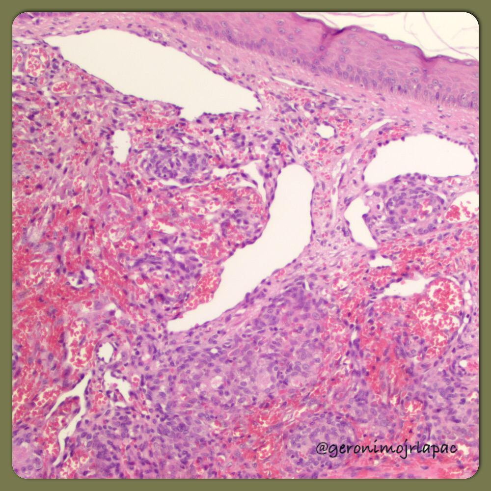 GeronimoJrLapac's tweet image. Kaposiform hemangioendothelioma.