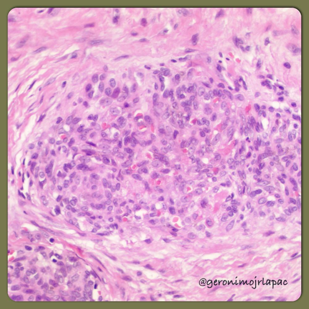 GeronimoJrLapac's tweet image. Kaposiform hemangioendothelioma.