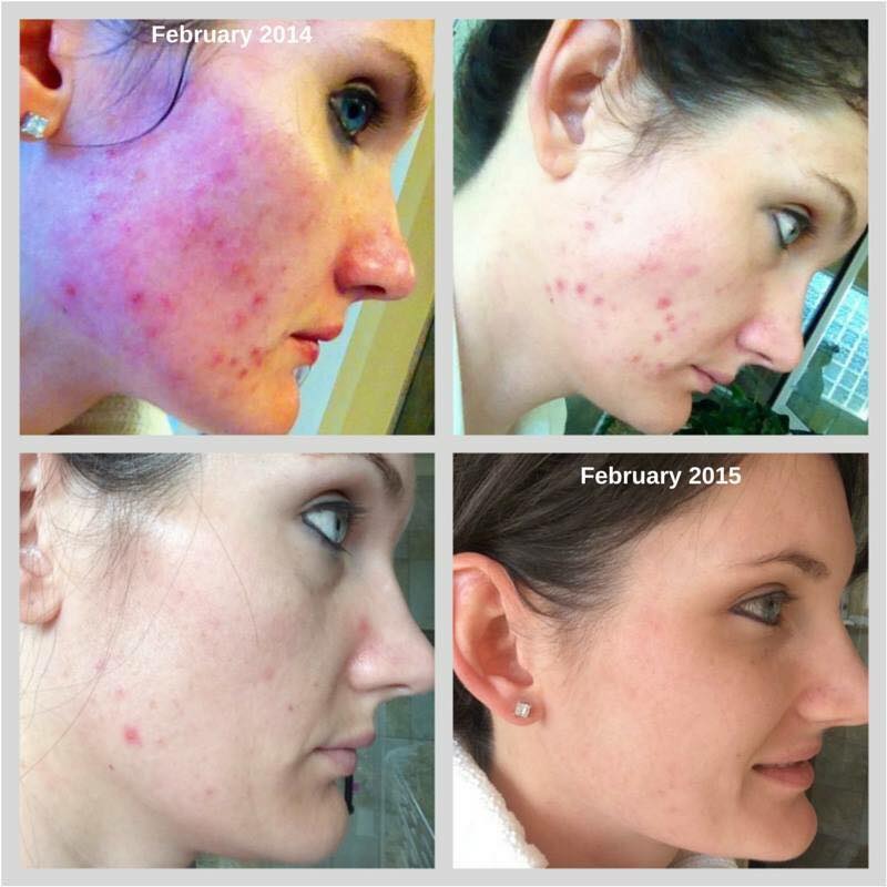 d_murphy6's tweet photo. Do you or someone you love lack confidence because of your skin? 60 day money back guarantee! Message me!#UNBLEMISH http://t.co/Kxcm1zFT6c