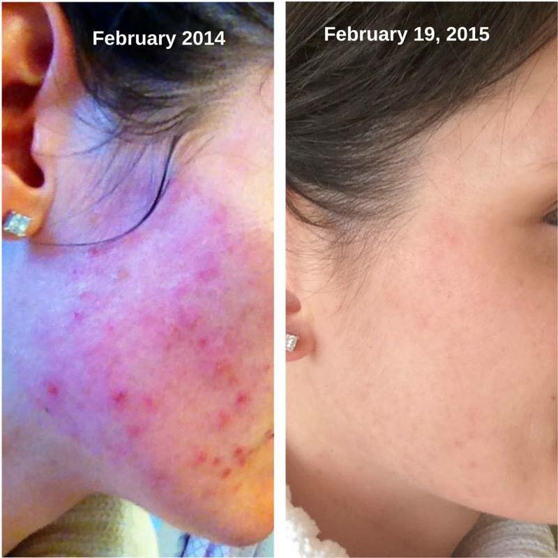 d_murphy6's tweet photo. Do you or someone you love lack confidence because of your skin? 60 day money back guarantee! Message me!#UNBLEMISH http://t.co/Kxcm1zFT6c