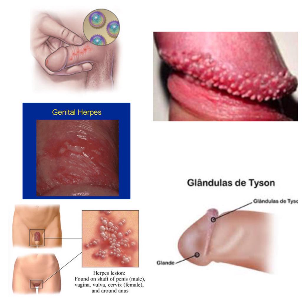 Diferencias entre el Virus del Herpes Genital y Las Pápulas Perladas .Para ...