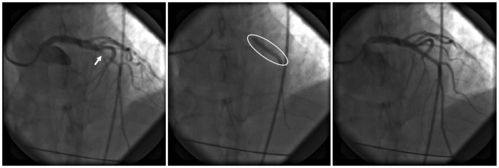 EMS12Lead's tweet image. What is a STEMI? An explanation for City Council. #EMS #CodeSTEMI
ecgmedicaltraining.com/what-is-a-stem…