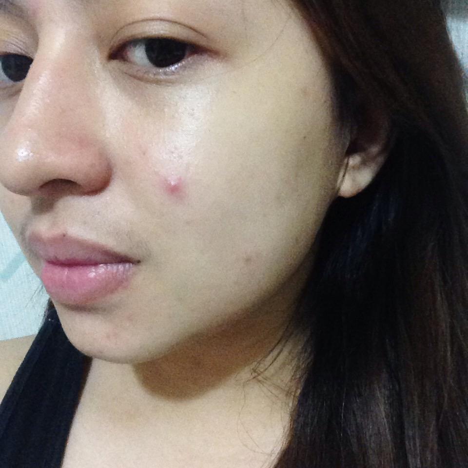 directLAEbor's tweet image. Haaay 😭 need to sleep #pimpleproblems