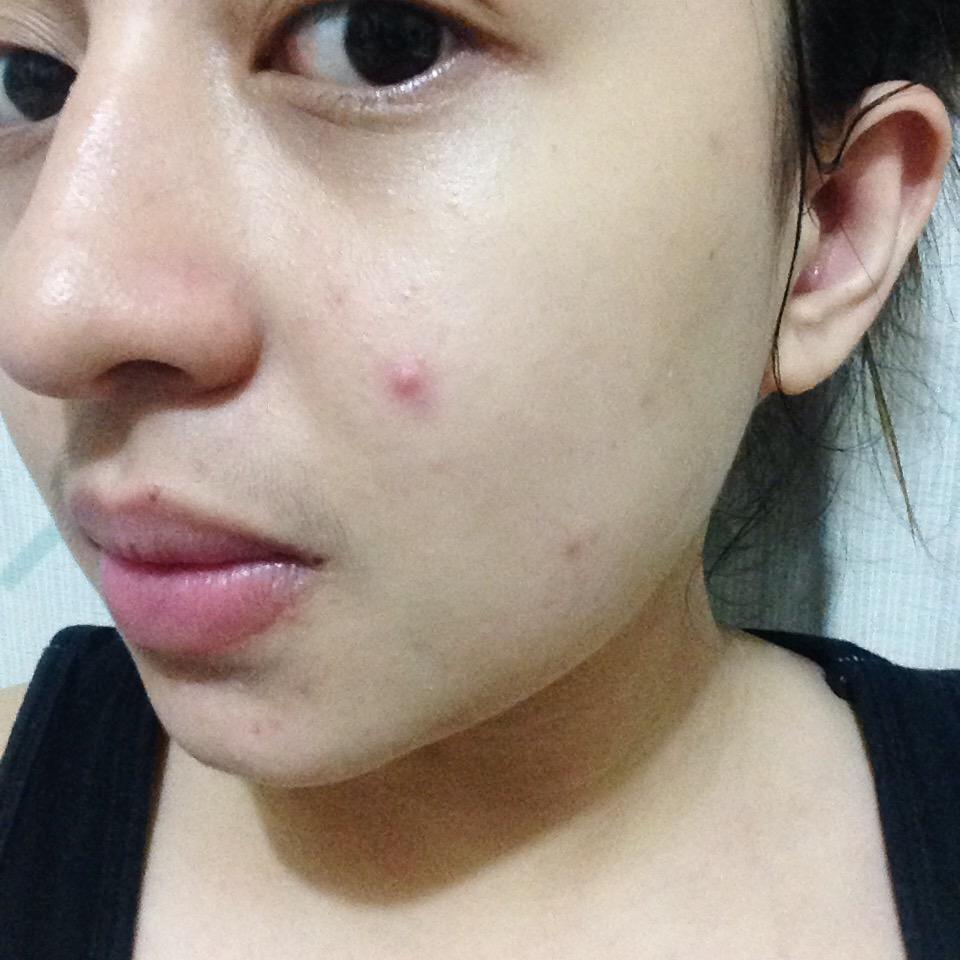 directLAEbor's tweet image. Haaay 😭 need to sleep #pimpleproblems