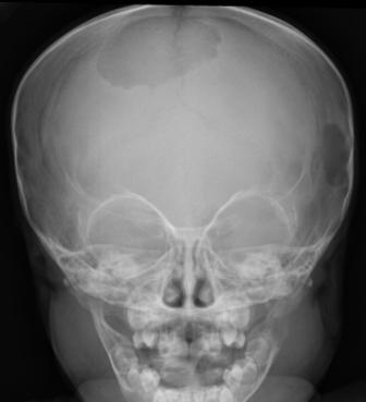 AosprCom's tweet photo. 16 month old girl with head lump and fever - http://t.co/53FHipL2Xb http://t.co/4HYxhhmvMs