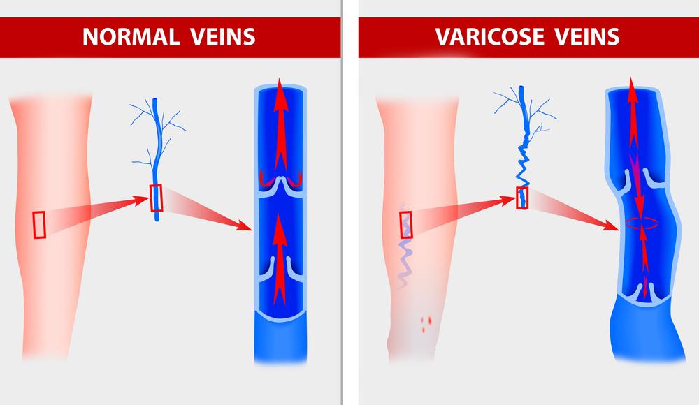 Varicose veins can cause feelings of discomfort and embarrassment. Call us for a consultation: 305.822.0068