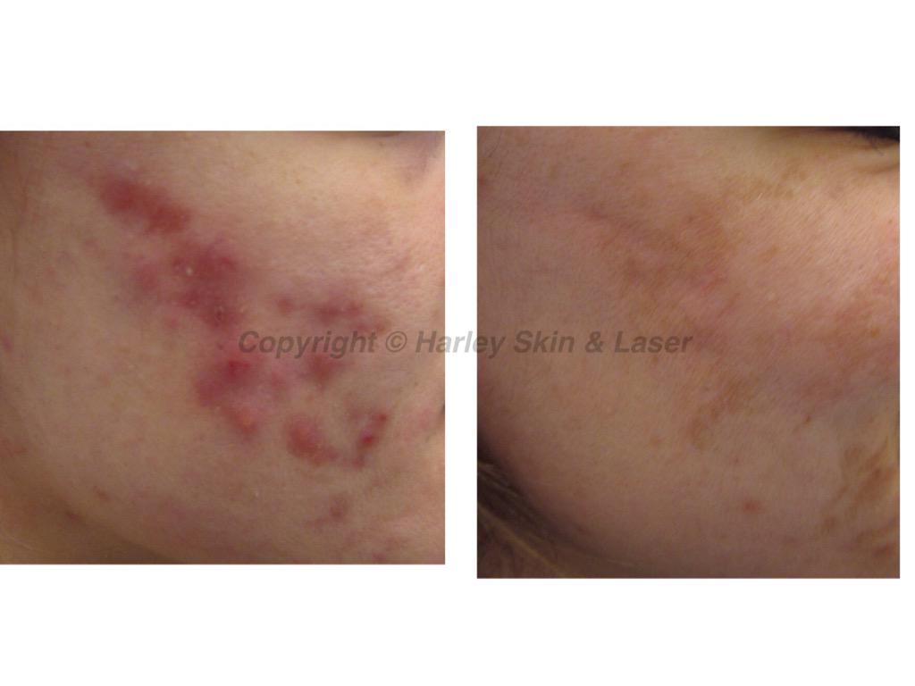harleyskinlaser's tweet photo. #acnetreatment #lyntonlasers #skingeeks #imageclearcelcleanser #harleyskinandlaser #lasertreatment #stokeontrent http://t.co/P1ucbKvxTo