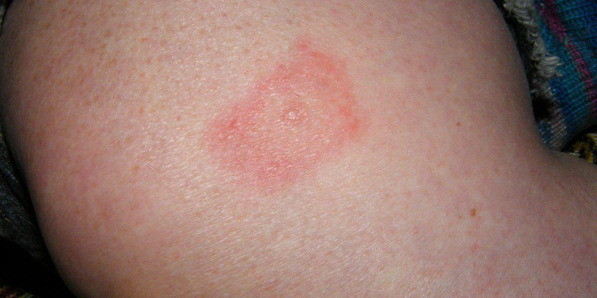 HeftyCo's tweet image. A mother posts pictures of her child’s rashes on Facebook. Minutes later she’s horrified. hefty.co/karen-mcgregor/