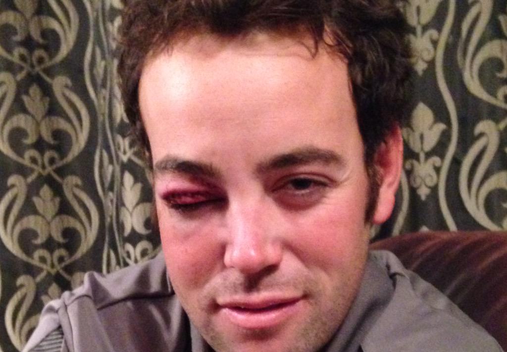 the_native_nz's tweet photo. Mate got kicked in the eye by rugby boot http://t.co/tenwPg9Hhp