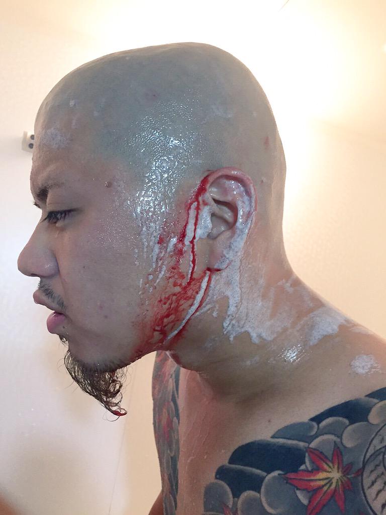 リキ 在 Twitter 上 今スキンヘッドの人 これからしよかなって思ってる人 2日に一回は剃らないと駄目だけどこうならないようにきおつけようね Http T Co Aeml8ukykh Twitter