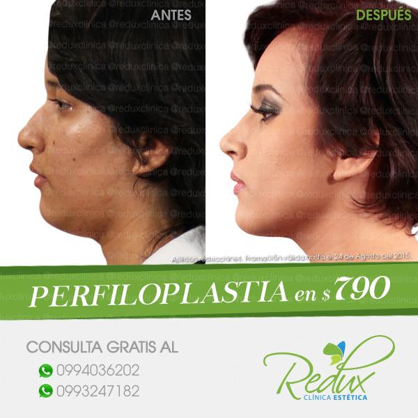 SecretosTV_'s tweet photo. Mira el #cambioredux de Joselyn con una #perfiloplastia en @ReduxClinica aprovecha la promoción  #ConsultaGratis http://t.co/b1wFTmTqu2