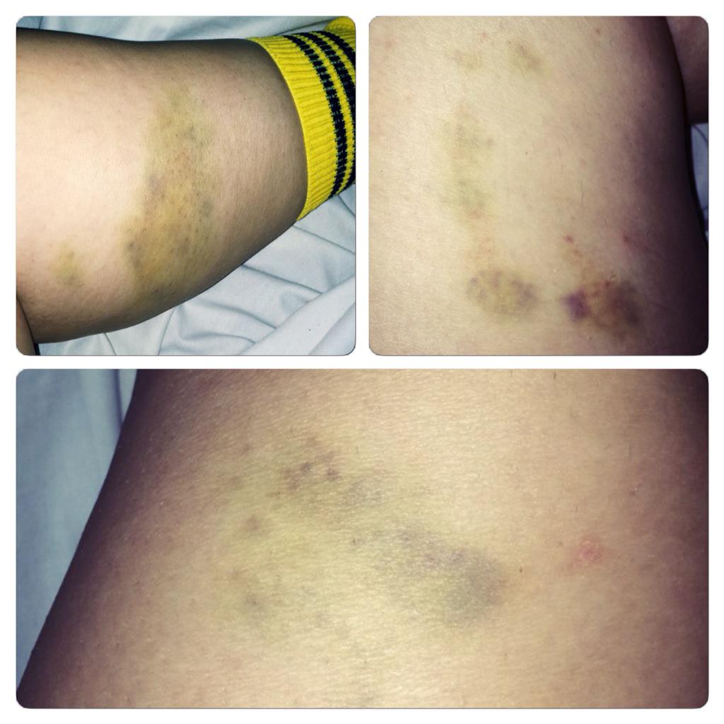 mimousse40's tweet photo. La reprise du #rugby ça donne ça.. #nosexappeal#dégeulasse🏉👌 http://t.co/tm6PY5bXoa
