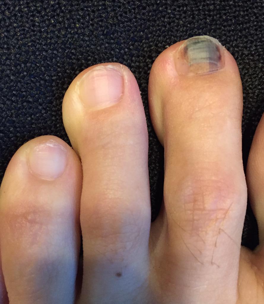 tryaginger's tweet photo. @KevinKleinLIVE You guys are gonna regret this. I busted up one of my toes recently. #ToeToeTuesday http://t.co/1u9p9ok58Q
