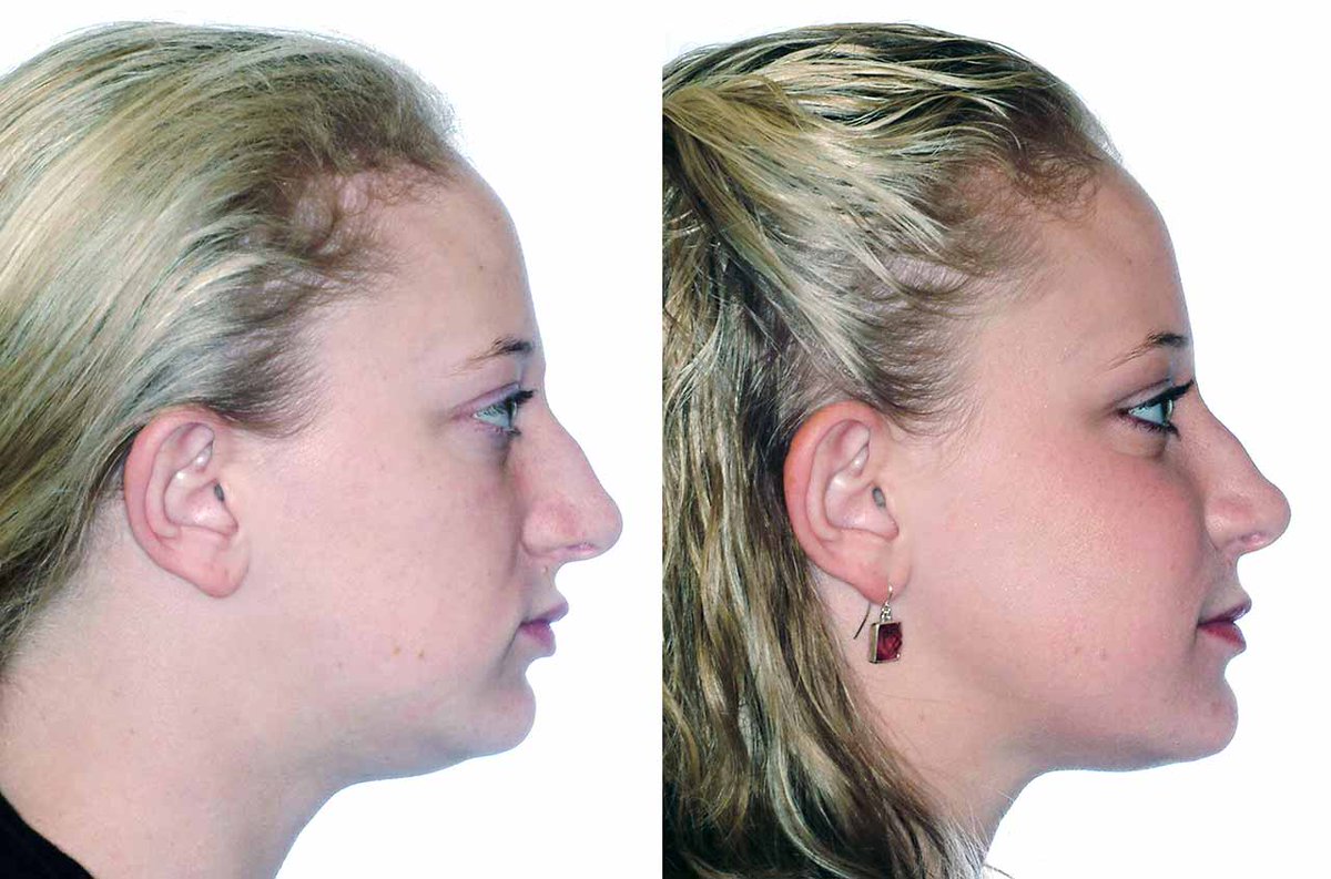 DrAntipov.com Frequently Asked Questions - click here: bit.ly/1hngW0Q <a href="/Smile4Health/">Hertha Latimer</a> <a href="/aaoms/">AAOMS - Oral and Maxillofacial Surgeons</a>