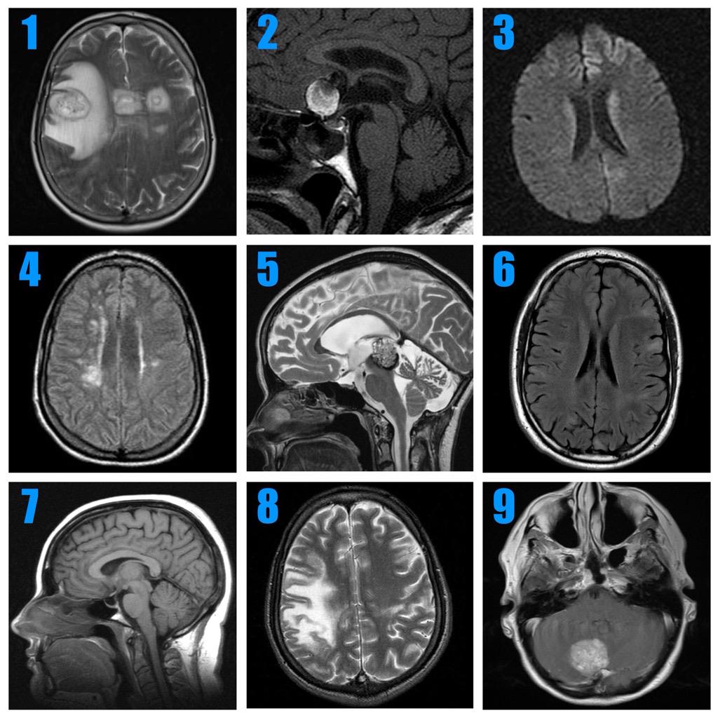 Manual Therapy for the Cranial Nerves