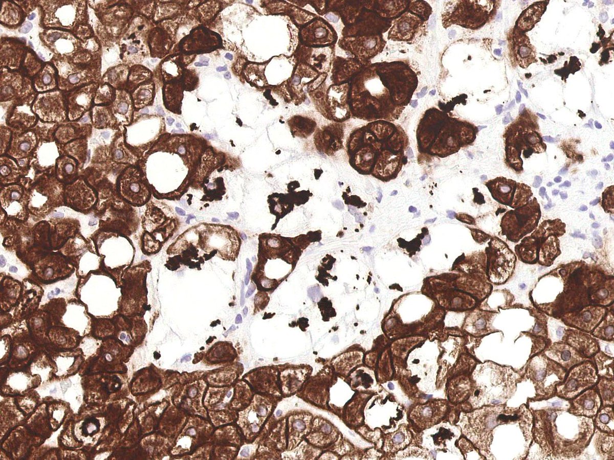 #Liver &amp; intrahepatic bile ducts-nontumor - Hepatitis - noninfectious - Nonalcoholic steatohepatitis #Pathology