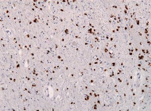 Multiple system atrophy is first new human prion disease identified in 50 years. <a href="/GENbio/">Genetic Engineering & Biotechnology News</a>: ow.ly/RE0IJ