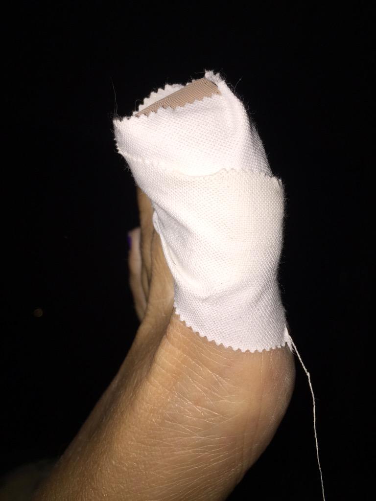 Leigh464's tweet photo. My toe before and after "surgery"! I dont know what bit me but it is killing me!!! http://t.co/NugFKlr0z7
