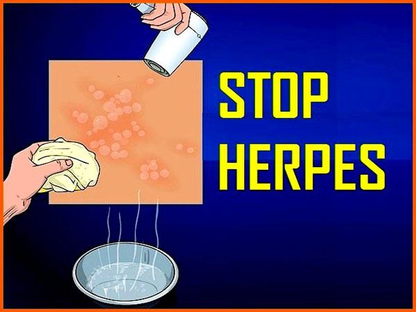Tips Cara Alami Mengobati Penyakit Herpes - AnekaNews.net